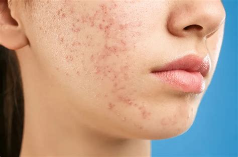 Cara Mengenali Munculnya Jerawat Pasir, Ini Penjelasannya