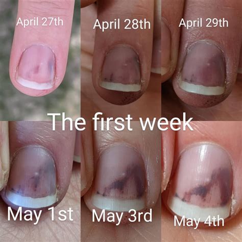 Healing of a bruised finger : r/MedicalGore