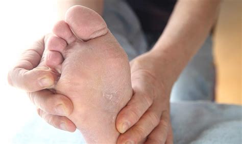 Why Are My Feet Peeling? - Feet First Clinic