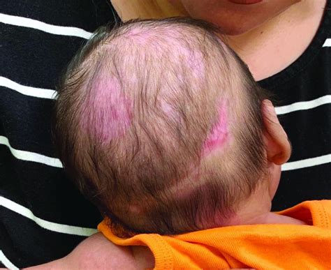 A 2-month-old infant with a scalp rash that appeared after birth ...