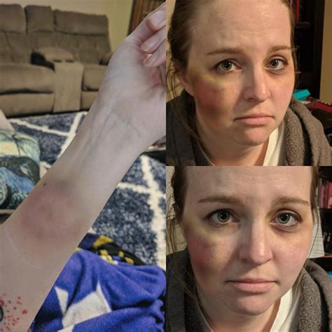 My first try at bruising on my sister and my own arm. I know it's not