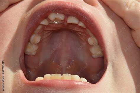 baby teeth of a child, an open mouth of a girl. background for the design. stomatology Stock ...