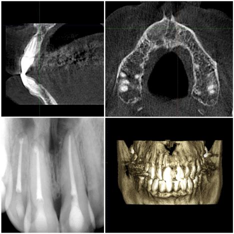 Nasopalatine duct cyst: A diagnostic dilemma
