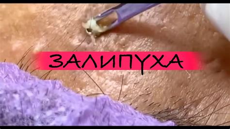 ПРЫЩИ ВЫДАВЛИВАНИЕ. ВЫДАВЛИВАНИЕ ПРЫЩЕЙ. ВЫДАВЛИВАНИЕ ЧЕРНЫХ ТОЧЕК НА ...