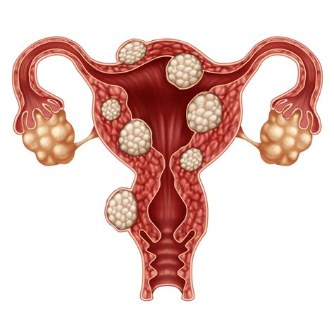 Fibroids vs. Cysts: What's the Difference? | New York City | 1 Fibroid