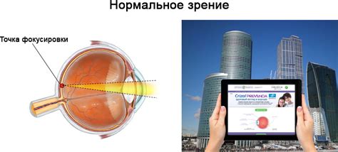 Контактные линзы при астигматизме