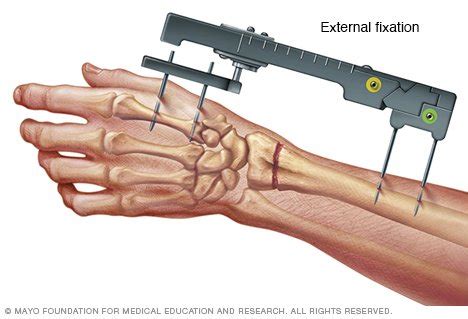 Broken wrist/broken hand Disease Reference Guide - Drugs.com