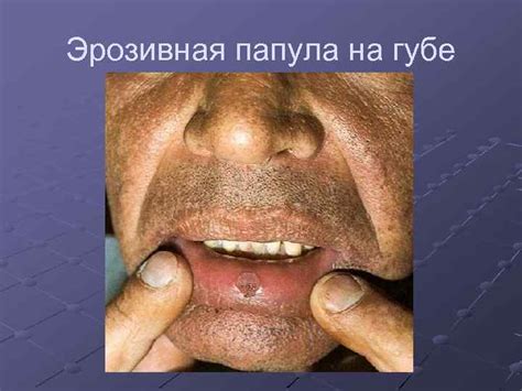 Первичный и вторичный сифилис Бледная трепонема