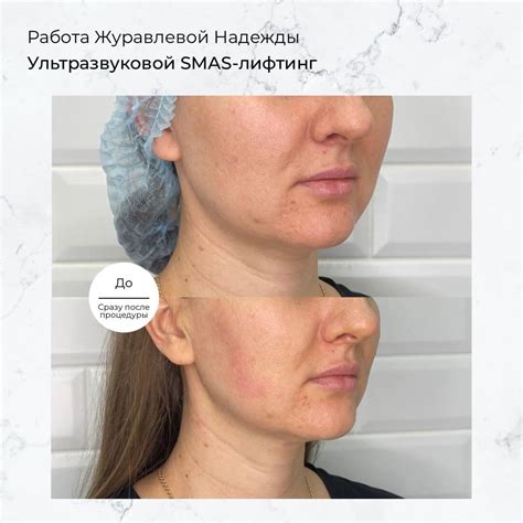 Ультразвуковой SMAS-лифтинг - Услуги