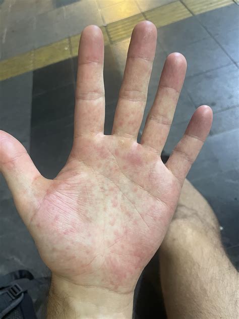 Itchy Palms Whats The Cause Hive Cures | What Causes Hives, Hives