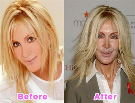 Celebrity Plastic Surgery Disasters. Before And After (16 pics)