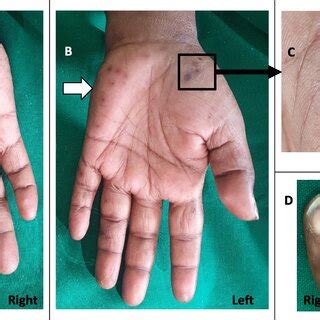 Pathways taken by septic emboli in anterograde arterial embolization ...