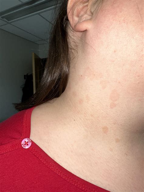 I’ve had these brown spot appear in my neck over the last few weeks ...