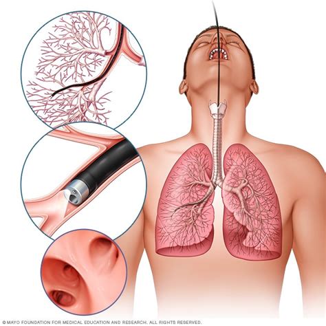 Bronchoscopy – Intelligent Haptronic Solutions Inc.