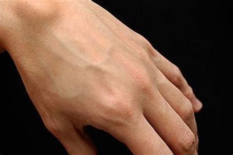 Гигрома кисти руки: лечение, операция, последствия