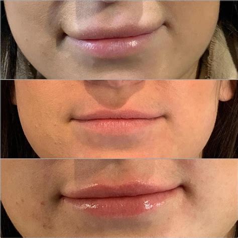Does Dissolving Lip Filler Make Your Lips Smaller | Lipstutorial.org