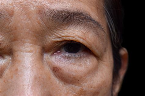 Med Journal 360 | Inactive orbital disease most common form of Graves ...