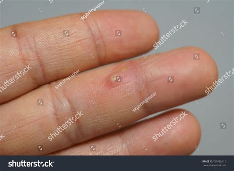Blister On Finger Stock Photo 751955611 | Shutterstock