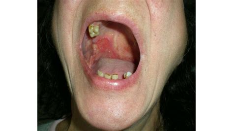Oral Squamous Cell Carcinoma: Mouth Cancer Symptoms and More