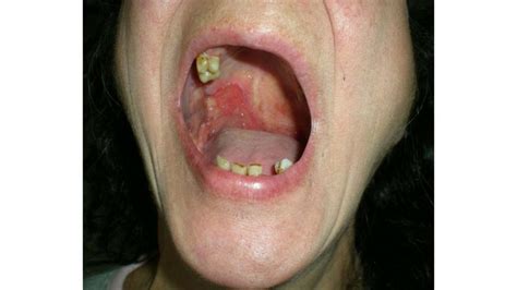 Oral Squamous Cell Carcinoma: Mouth Cancer Symptoms and More