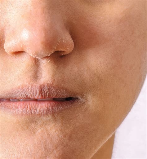 Dry Skin Around Nose: Top 6 Causes And Quick Remedies