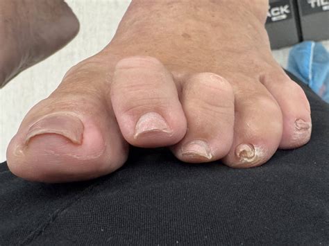 Hammertoe Before and After Photos | Northwest Surgery Center