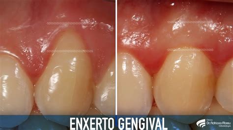 Enxerto Gengival Antes E Depois - Doenca Gengival Antes E Depois Periodontologia, O Que é? Célia