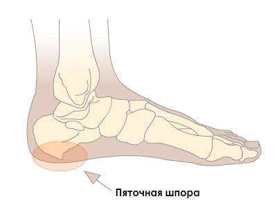 Пяточная шпора, причины, симптомы, лечение - travmasport