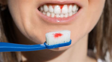 how to cure periodontitis gum disease at home