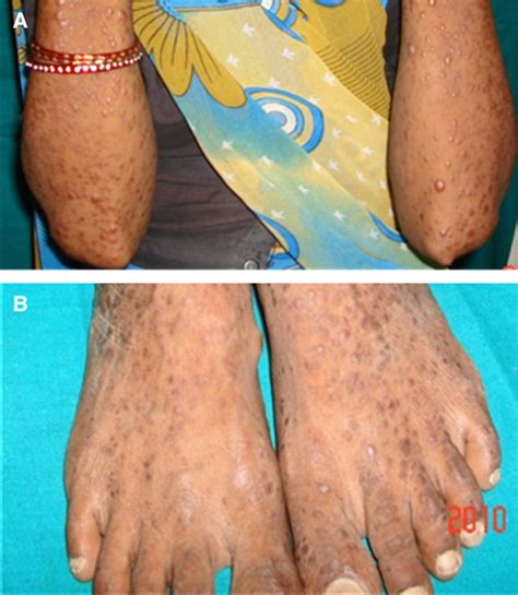 Diffuse Cutaneous Leishmaniasis