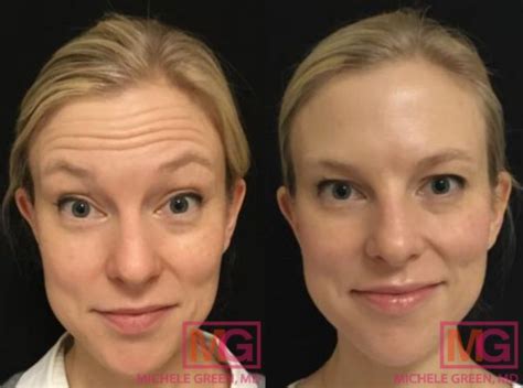 Botox Before & After Photos, Patient Photo, Pictures