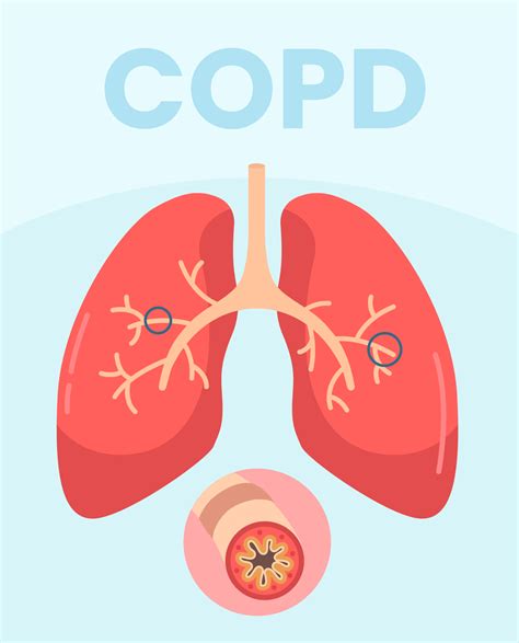 Chronic Obstructive Pulmonary Disease - SynappseHealth