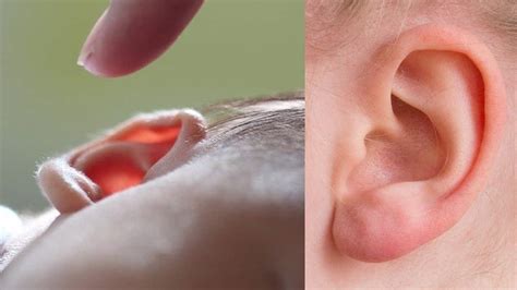 sakit telinga bagian  perumperindocoid