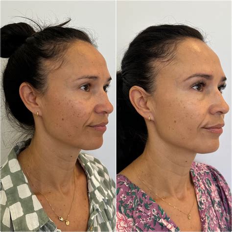 Botox, Jeuveau & DAXXIFY Wrinkle Relaxers in Boulder, CO