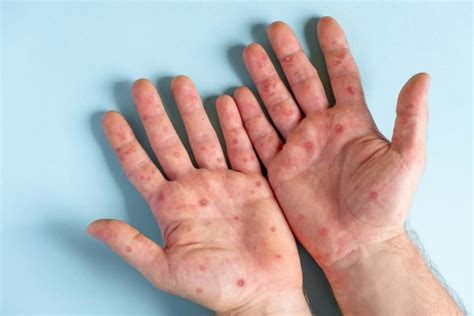 telapak tangan gatal muncul bintik berair kenali  penyebab