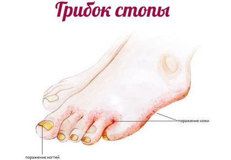 Микозы стоп, его виды и методы лечения – запись к врачам в Москве