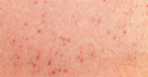 Folliculitis: Symptoms, Treatment and Prevention