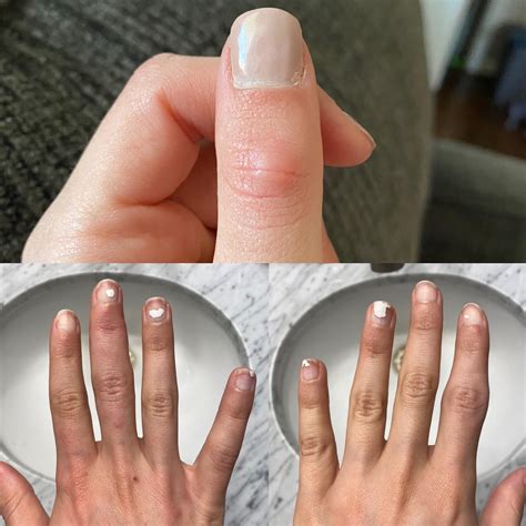 finger nodules arthritis rmedical