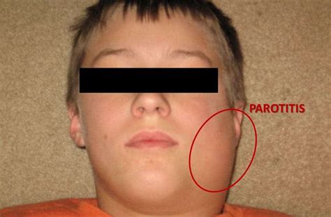 parotid gland infection parotid gland abscess hsiwa