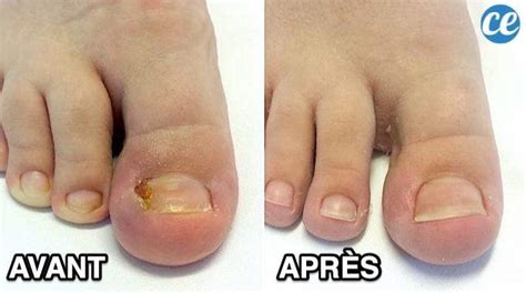 Ongle Incarné : 8 Remèdes Rapides et Efficaces Pour S'en Débarrasser.