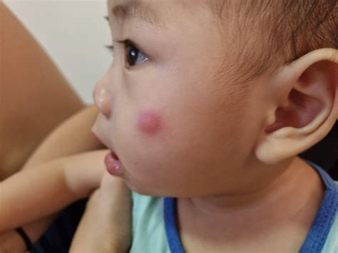 What is this? Flea bite? : r/babies