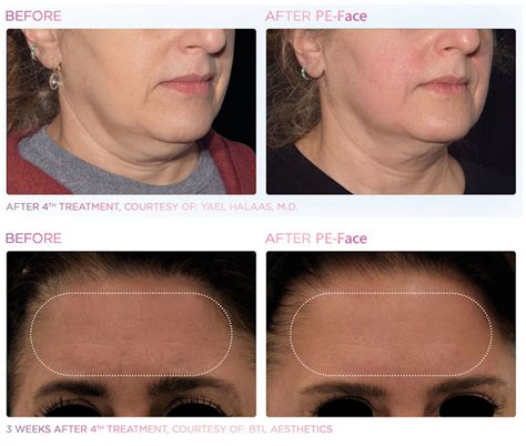 2023 Newest facial emsculpt slim ems pe face lift machine – Guangzhou ...