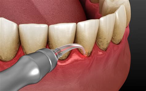 Dental Laser Classification at JENENGE blog