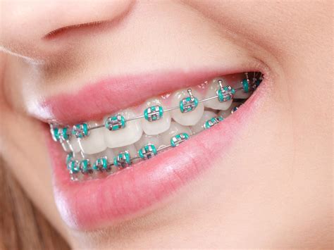Interesting Facts About Braces Newark | Dr. Nancy Quach