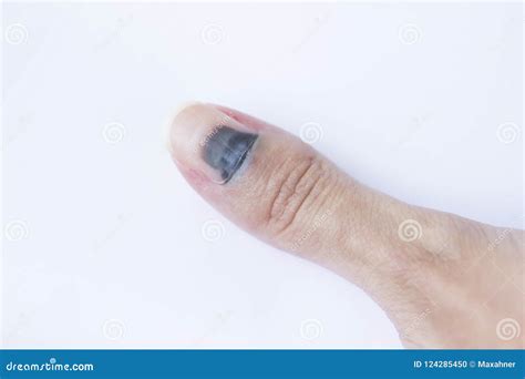 The Outcome after the Hit. Close Up Shot of a Bruised Nail. Stock Photo ...