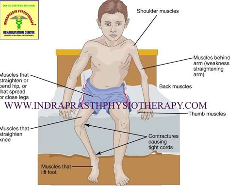 INDRAPRASTH PHYSIOTHERAPY CENTRE: POLIOMYELITIS
