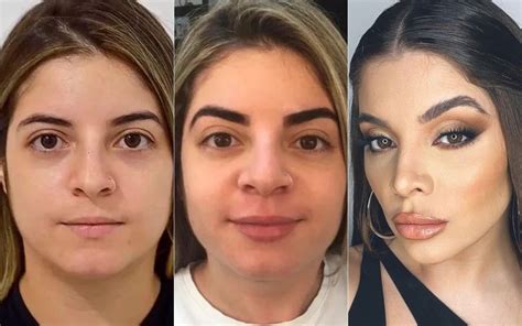 Gkay Antes E Depois Cirurgia
