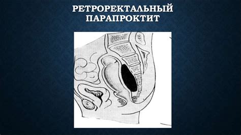 Острый и хронический парапроктит - презентация онлайн