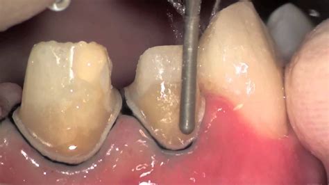 Tooth preparation under microscope, root canal treatment. Nazariy ...