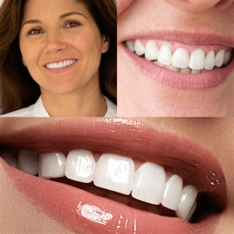 veneer dentist    complete guide   radiant smile